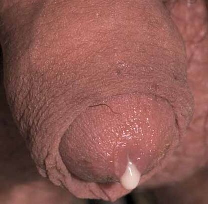 descarga patológica quando excitado